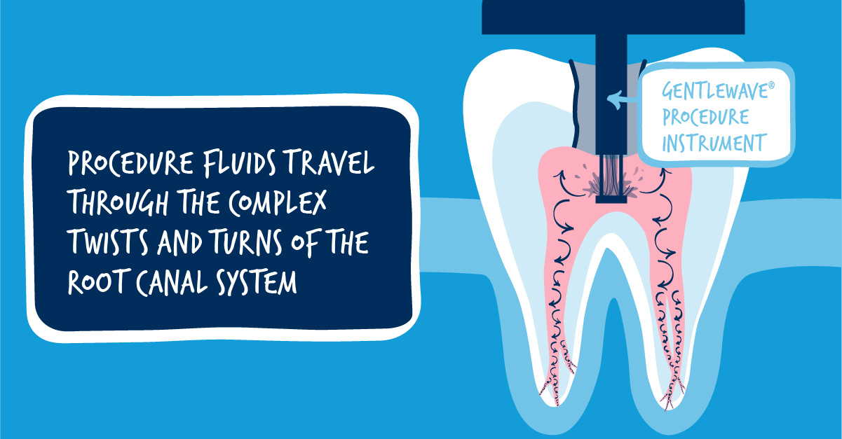 The History of Root Canal Treatment GentleWave Procedure